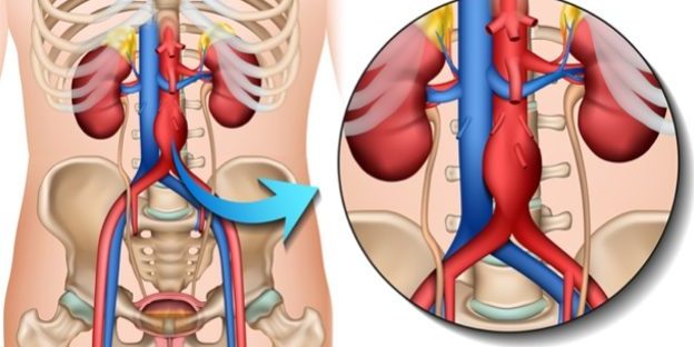 Aorta-Aneurysma-Diagnose-624×425