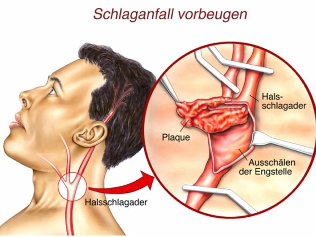 Halsschlagader Aorta Operation