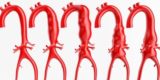 Aorta-Aneurysma-624×425 Aorta Aneurysma