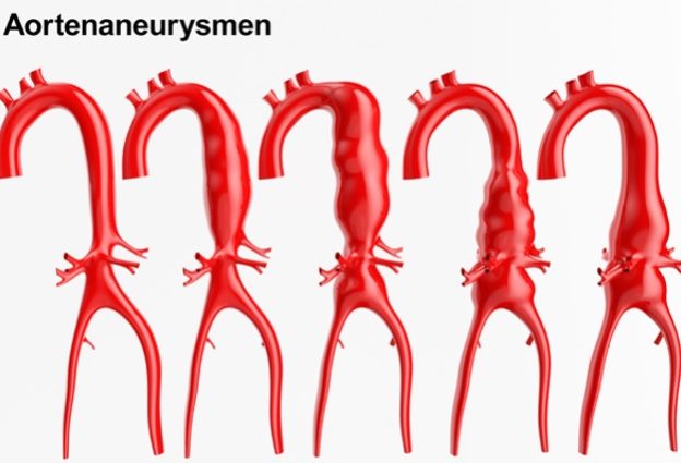Aorta Aneurysma