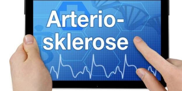 Aorta-Arteriosklerose-.624×424 Aorta Arteriosklerose