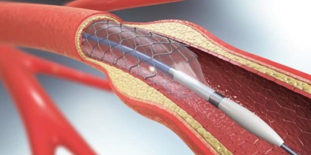 Aorta-Arteriosklerose-Behandlung-624×425 Aorta Arteriosklerose Behandlung