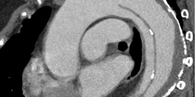 Aorta Dissektion Schmerz