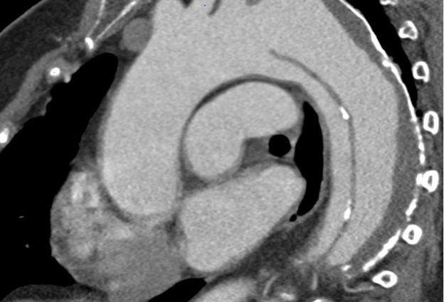 Aorta Dissektion Schmerz