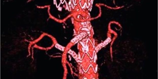 Aorta Stent