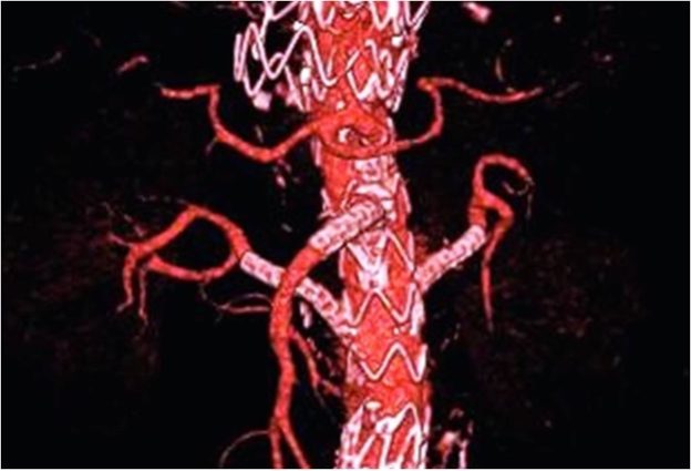 Aorta Stent