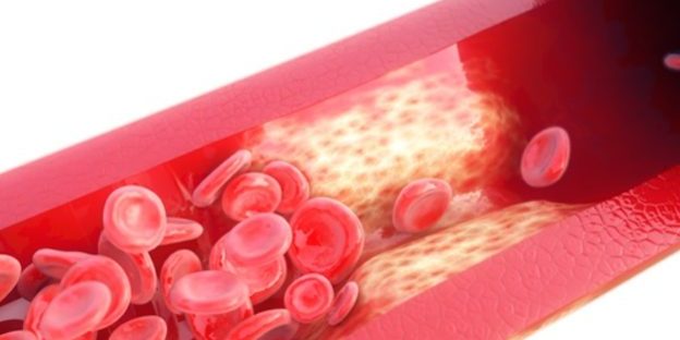 Aorta-Verkalkung-624×425 Aorta Verkalkung