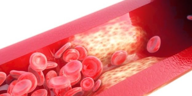 Aorta-Verkalkung-Arterie-624×423 Aorta Verkalkung Arterie