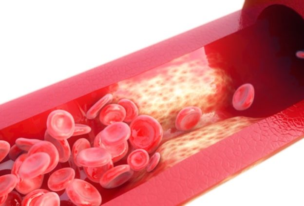 Aorta Verkalkung Arterie