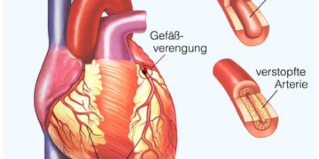 Aorta Verschluss