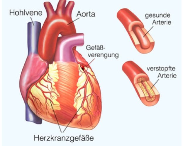 Aorta Verschluss