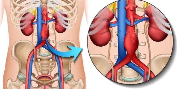 Aorta mit Aneurysma / Aorta Klinik