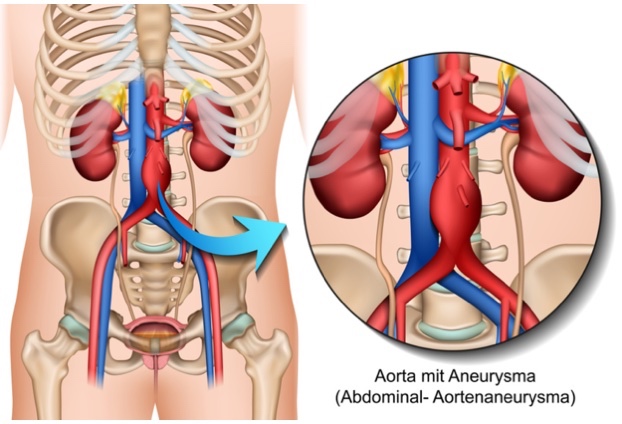Aorta mit Aneurysma / Aorta Klinik Siegen