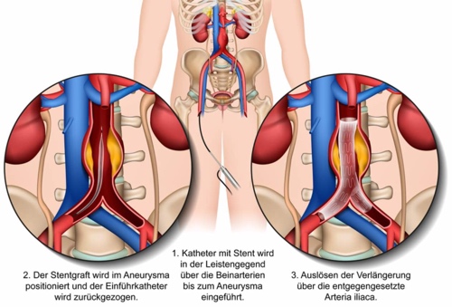 Aorta endovaskuläre Therapie