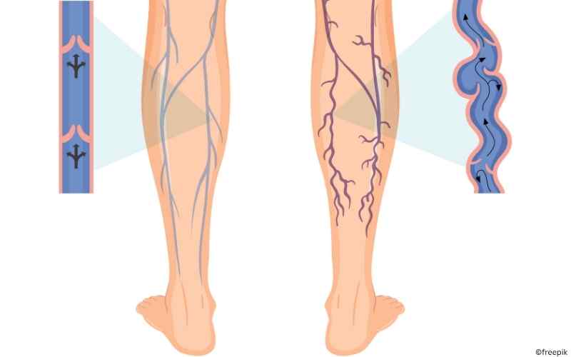 grafische Darstellung zweier Unterschenkel, einer mit gesunden Venen, einer mit kranken Venen.