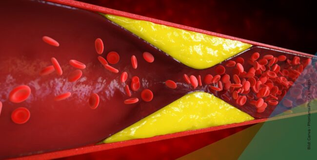 Darstellung einer Arterien-Verengung zum Thema Ischämie: Wenn eine Durchblutungsstörung zum Notfall wird