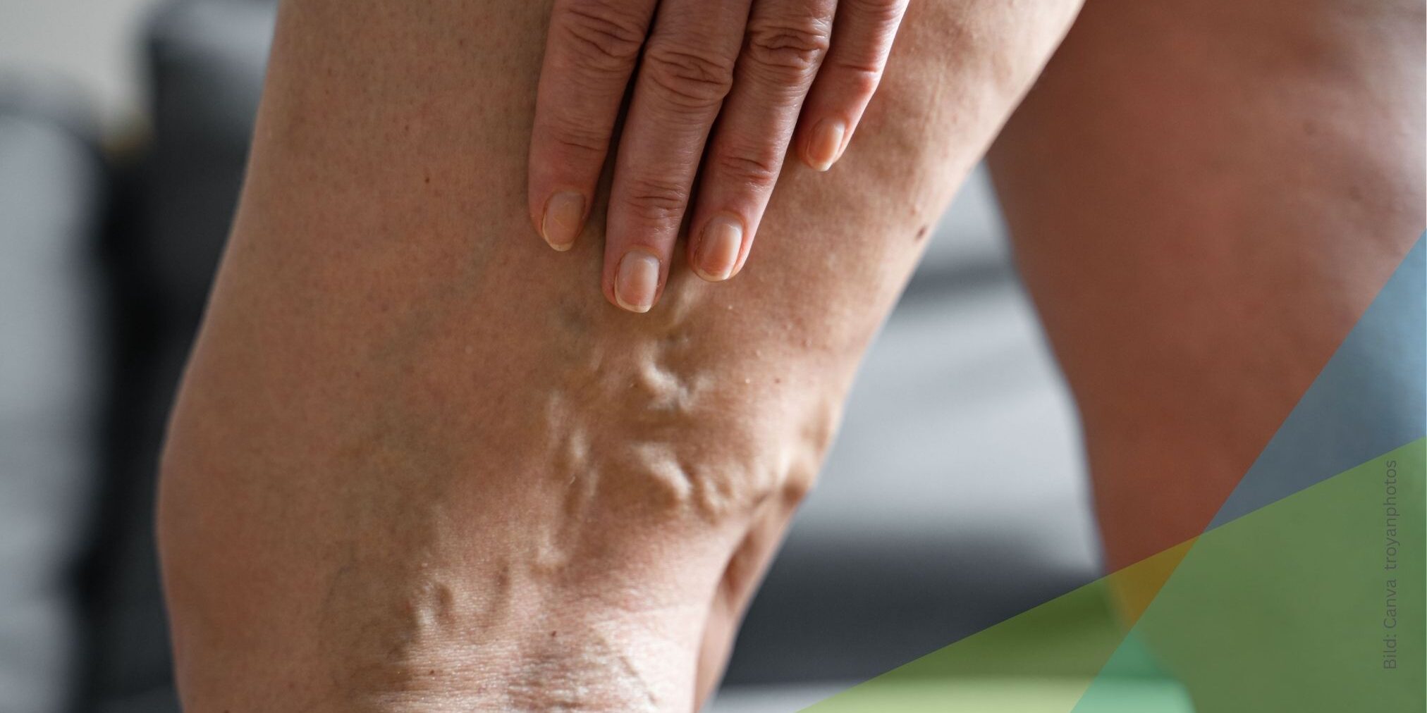 Nahaufnahme Krampfadern in der Kniekehle zum Thema Was bedeutet die Diagnose Varikosis