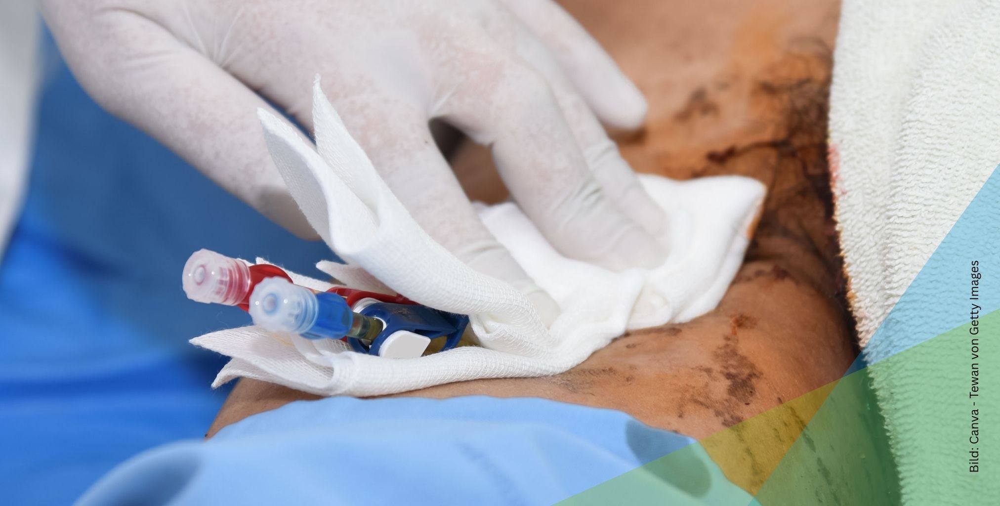 Shunt Dialyse: Der Gefäßzugang für eine sichere Hämodialyse