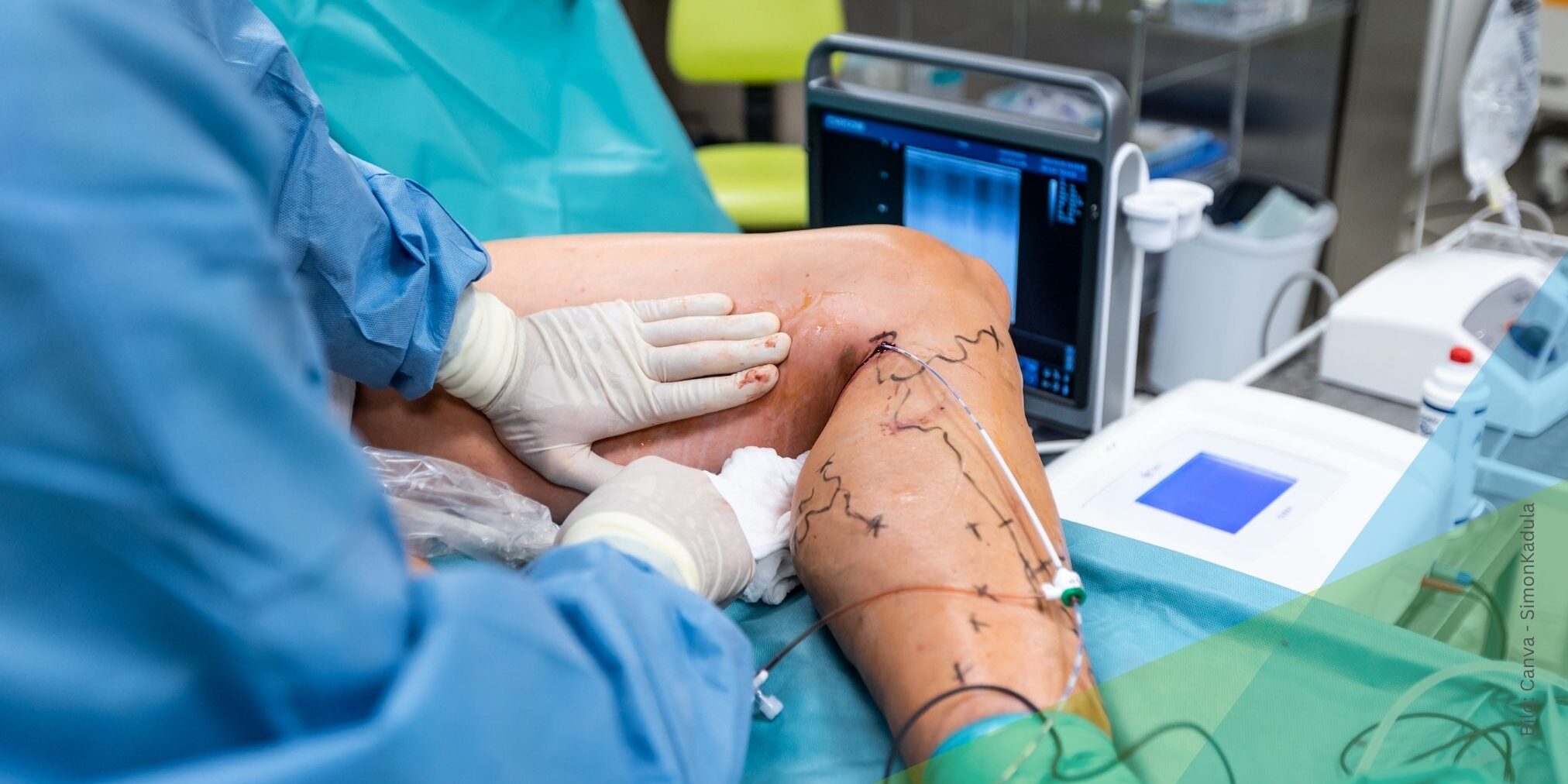 varizenblutung-wenn-krampfadern-ploetzlich-bluten Varizien Operation zum Thema Varizienblutung